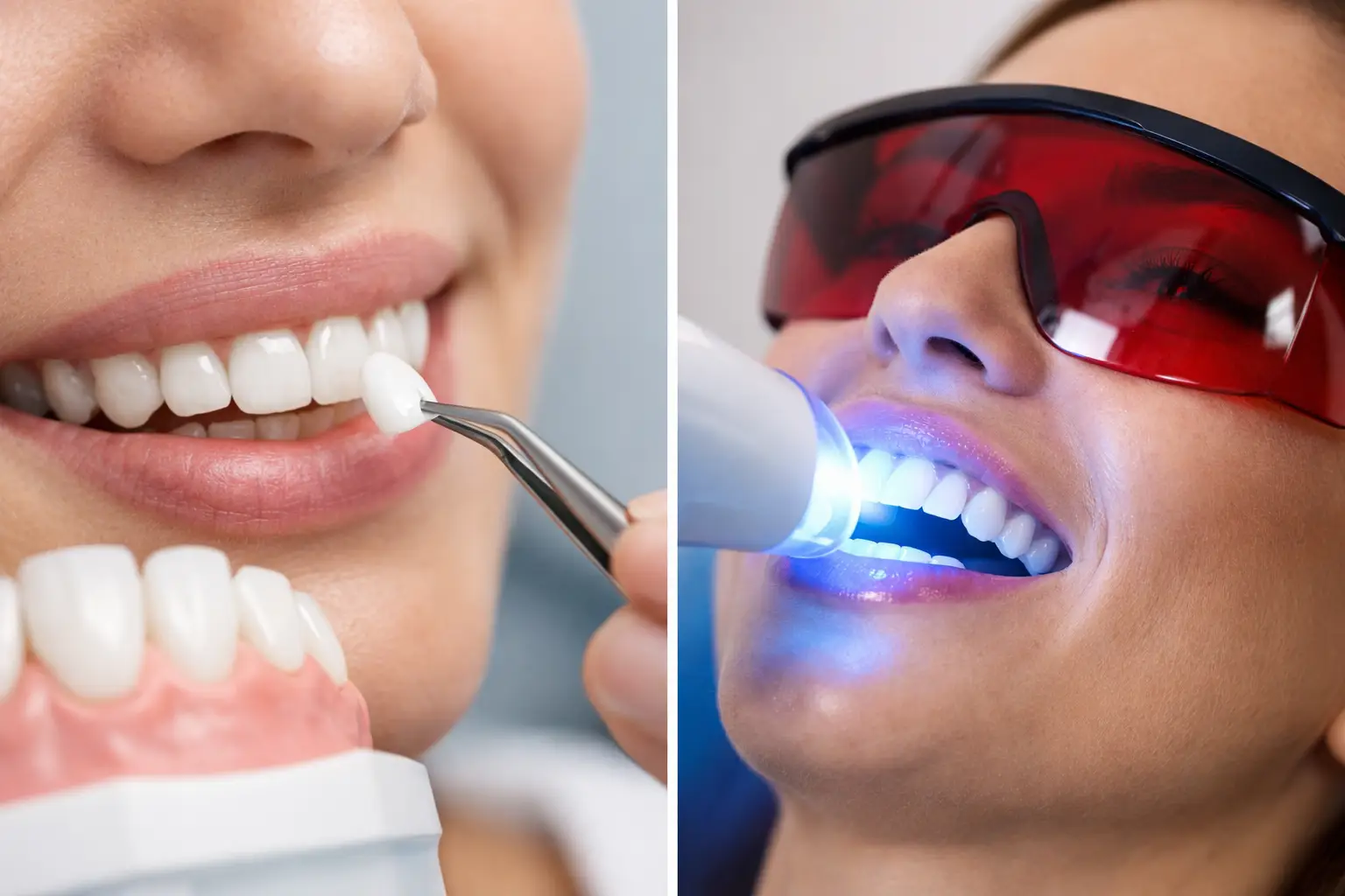 Veneers vs Teeth Whitening - Which Is Right?